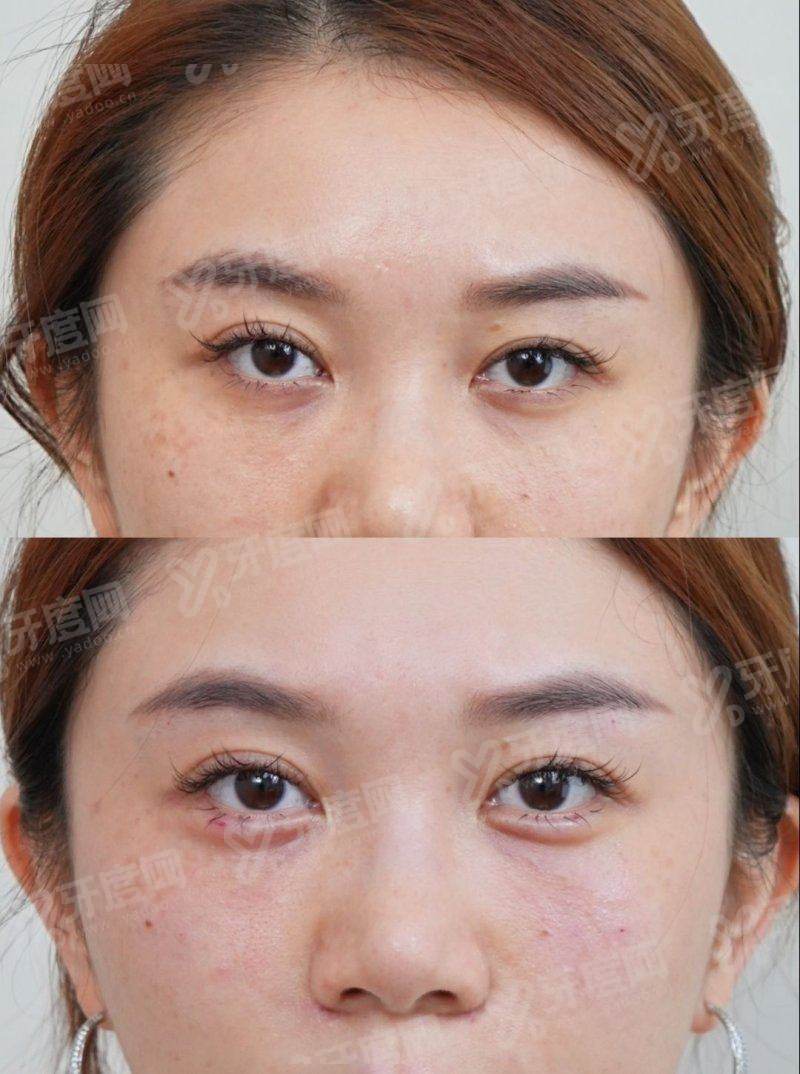 一、郑州东方整形美容医院朱怡梦卧蚕整形手术成功几率高吗?yanke.yadoo.cn