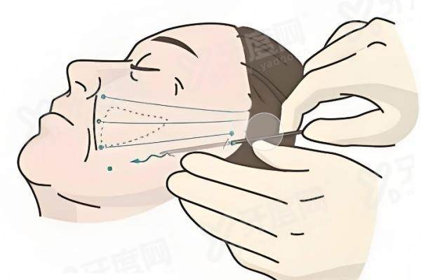 北京杨俊面部提升效果怎么样？分层抗衰技术自然紧致，预约便捷口碑好评如潮