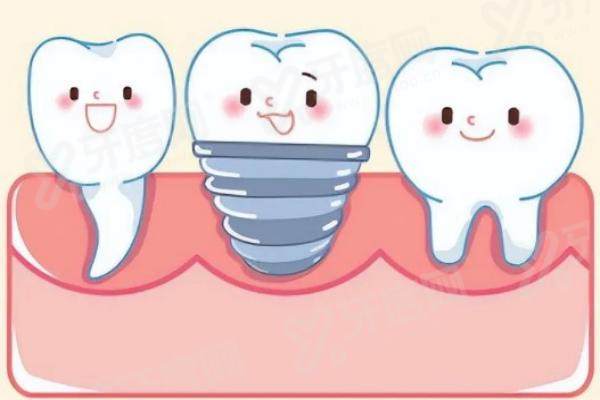 无锡贝壳口腔医院做全口种植牙多少钱？6 万起技术稳，全口种植效果自然更安心