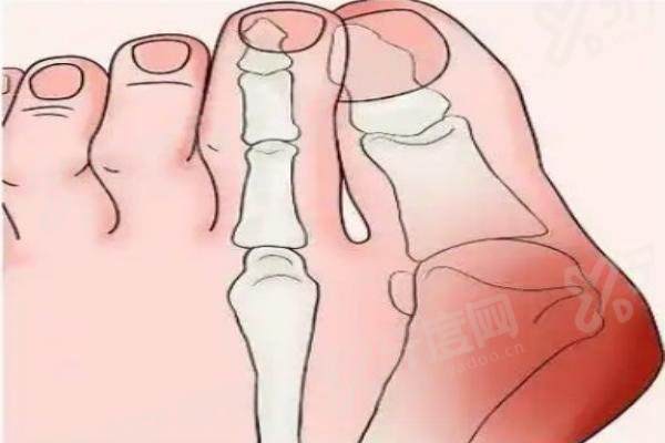 北京陈圣英医生做大脚骨怎么样？微创矫正技术好收费透明地址在朝阳