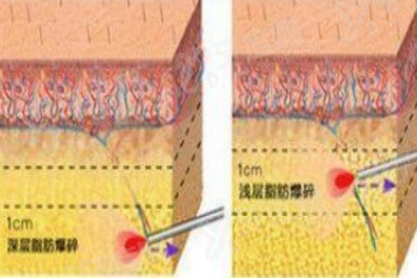 李春财吸脂效果怎么样？分层精雕技术好，附坐诊医院与预约方式