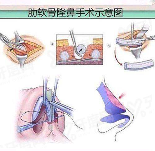 深圳富华整形医院做鼻子怎么样吗？好|技术实力强的医生团队和丰富的成功实例