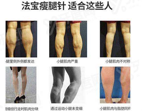 台州维多利亚医疗美容医院哪个医生做得好？李华医生以精细操作和自然成效著称