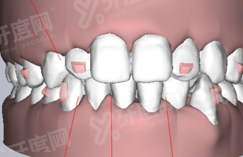 三、种植牙诺贝尔RCC和PMC适用人群？（根据牙槽骨条件和种植需求划分）yanke.yadoo.cn