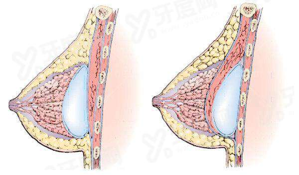 深圳田浩隆胸医生技术怎么样？内窥镜双平面自然无痕，价格 2 万起透明合理