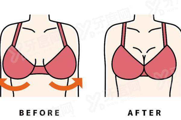 石家庄假体隆胸价格表：1.68万起透明收费，内窥镜双平面技术好
