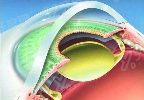 石家庄爱眼眼科医院院长资深专家领衔屈光手术精准矫正视力清晰