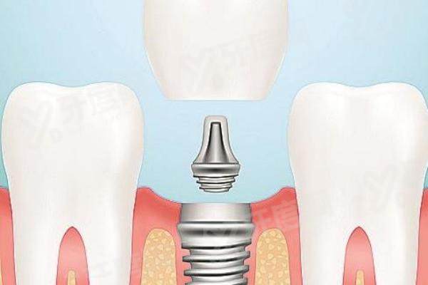 平顶山植得口腔医院价格表：种植牙2980元起，数字化种植技术好，收费透明放心选