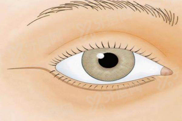 龚卫华医生做双眼皮怎么样？微创技术自然灵动，坐诊三甲医院号源充足无需担忧