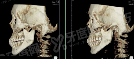 二、牟南虎吸脂实例分享yanke.yadoo.cn