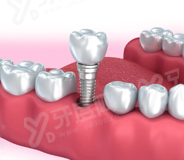二、鄞州鼎植口腔医院预约挂号yanke.yadoo.cn
