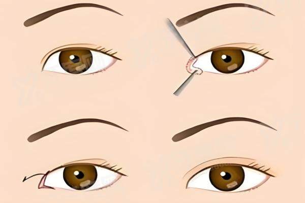 青岛诺德哪位医生做双眼皮好？谢尚生副院长手术创伤小恢复快，80后妈妈术后减龄！