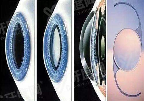 二、东莞友华普惠眼科医院的医生做手术稳不稳？yanke.yadoo.cn