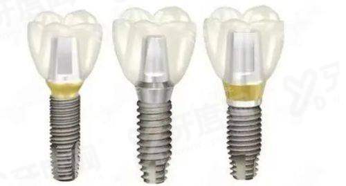 美国皓圣植体是亲水性吗？ETIIINH与SA型号是亲水种植体，质量好价格低