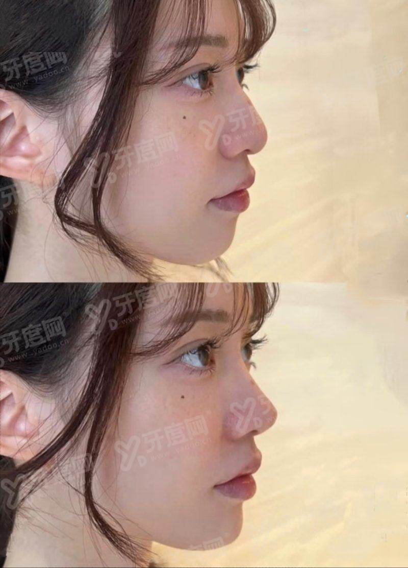 张家界维纳斯整形医院做鼻子好吗；鼻部整形技术精湛医生团队经验丰富效果自然满意度高