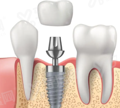 三、中山暨博口腔医院怎么样？是正规连锁医院，技术靠谱yanke.yadoo.cn