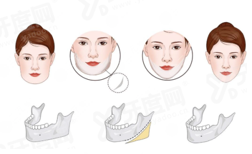 二、贾亮医生修复双眼皮怎么样？yanke.yadoo.cn