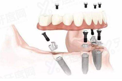 二、兰州星德口腔医院价格表？（2024年部分项目价格参考）yanke.yadoo.cn