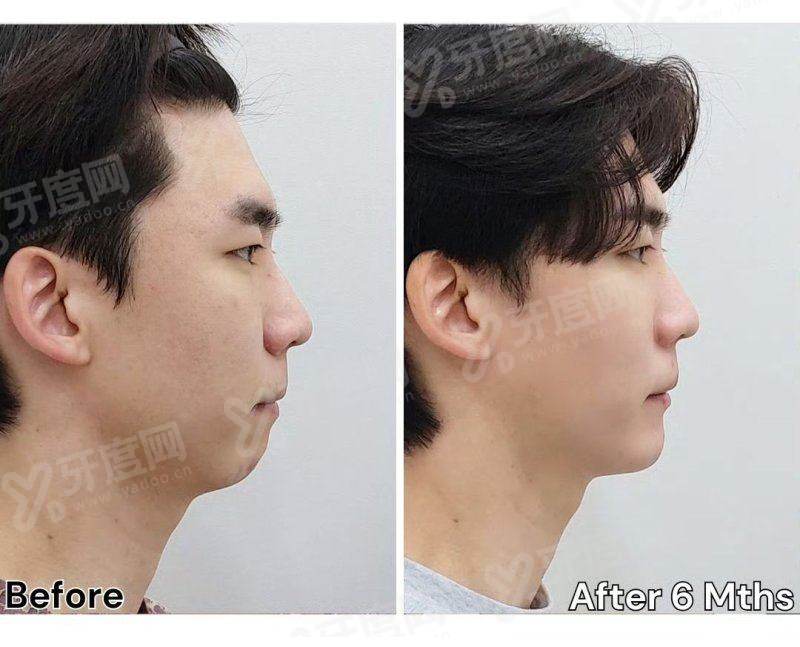 釜山麗諾RENOVO 整形外科怎么样？技术靠谱价格透明地址便利放心选