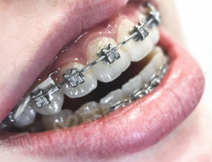 二、平湖数字化种植牙价格透明吗yanke.yadoo.cn