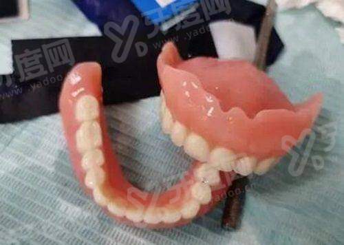 二、百齿泰种植牙使用寿命多久？20年左右yanke.yadoo.cn