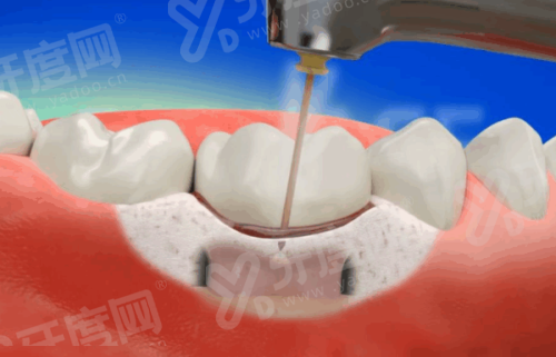 一、南京金铂利口腔医院技术水平：种植矫正技术靠谱yanke.yadoo.cn