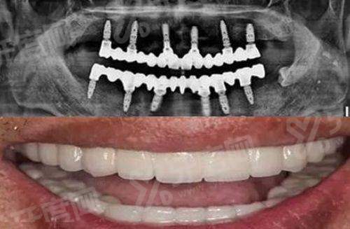 新疆伊犁福宏林口腔医院正规吗？卫健委审批持证，数字化种植技术强且价格透明无隐形消费口碑赞