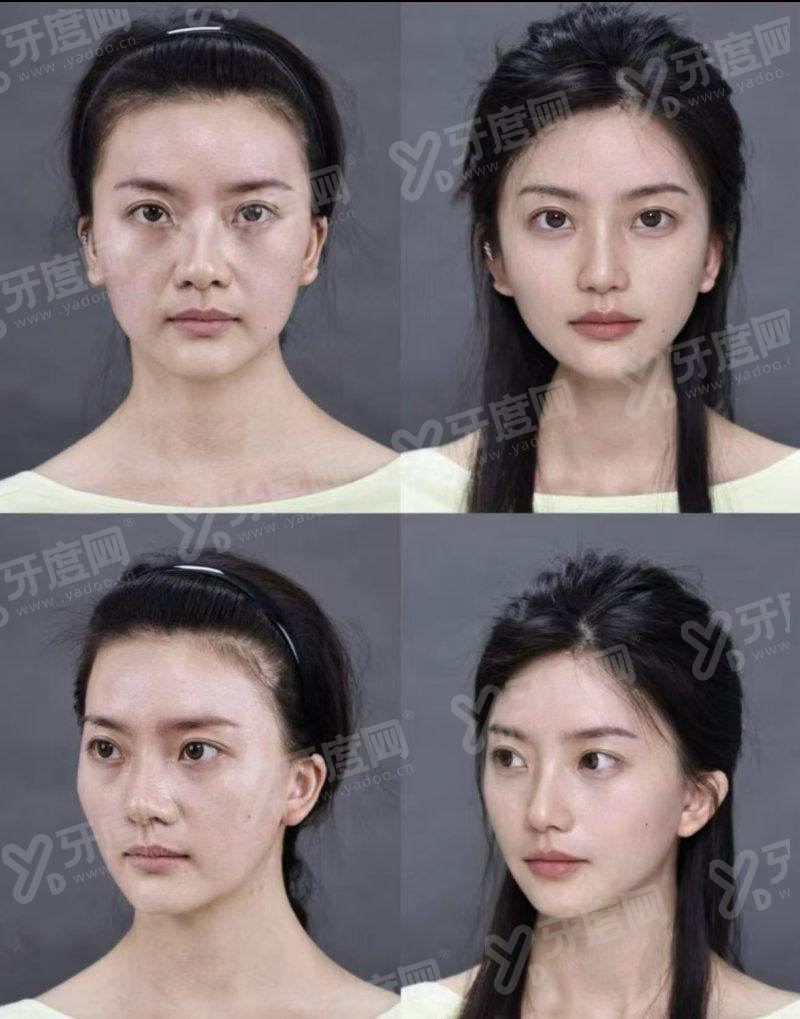 佛山曙光金子医学美容医院价格表多少？双眼皮 3980 元起，真实口碑好，变美更安心！
