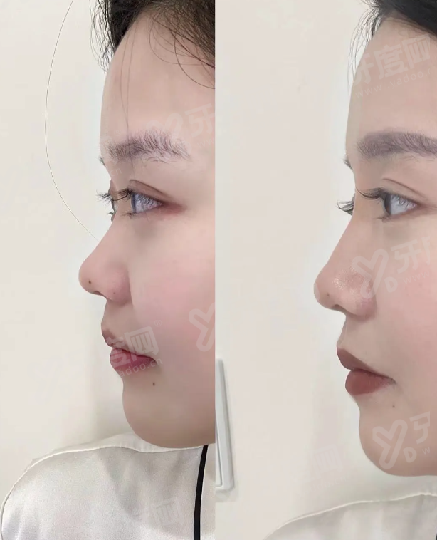 二、佛山曙光金子医学美容医院丰胸实例分享：真实反馈见证出色品质yanke.yadoo.cn