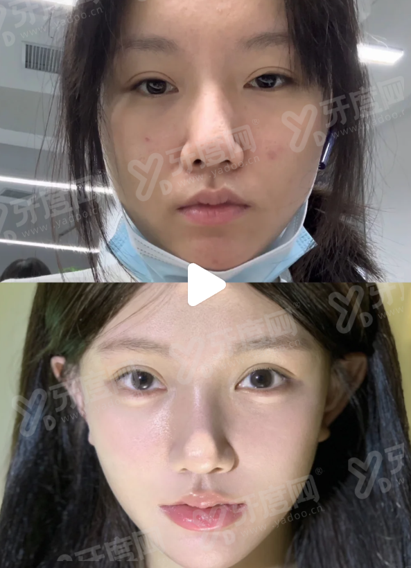 佛山曙光金子医学美容医院技术好吗；专业团队打造自然灵动之美效果真实看得见