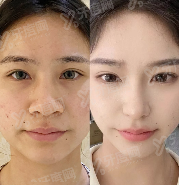 一、佛山曙光金子医学美容医院丰胸怎么样？yanke.yadoo.cn