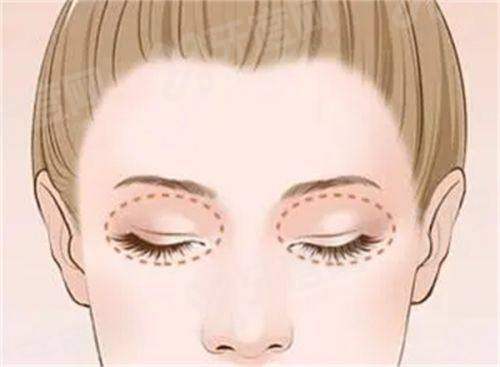 二、深圳非凡易培金医生做双眼皮多少钱？yanke.yadoo.cn