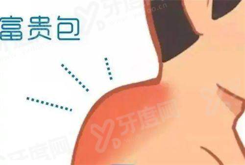 刘学宝富贵包治疗真实案例效果:微创切口小恢复快,颈部线条自然平整