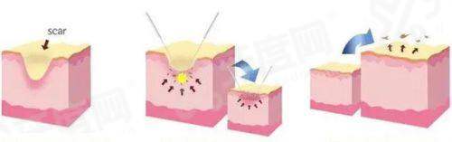 二、福州海峡整形医院双眼皮多少钱？yanke.yadoo.cn