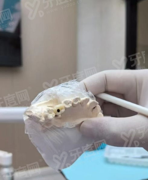 佛山补牙价格表多少？300 元起修复蛀牙，透明收费无隐形消费，让笑容更自信！