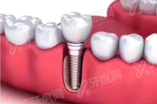 想知道乌鲁木齐牙博士口腔医院费用高吗？不高，透明计费无隐形消费，价格表公开亲民