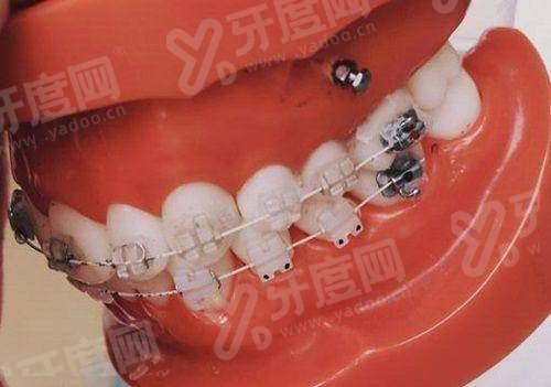 二、西捷美牙冠的优点及缺点yanke.yadoo.cn