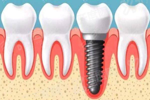 西安圣贝口腔医院是公立还是私立？正规私立，种植/正畸技术好附价格