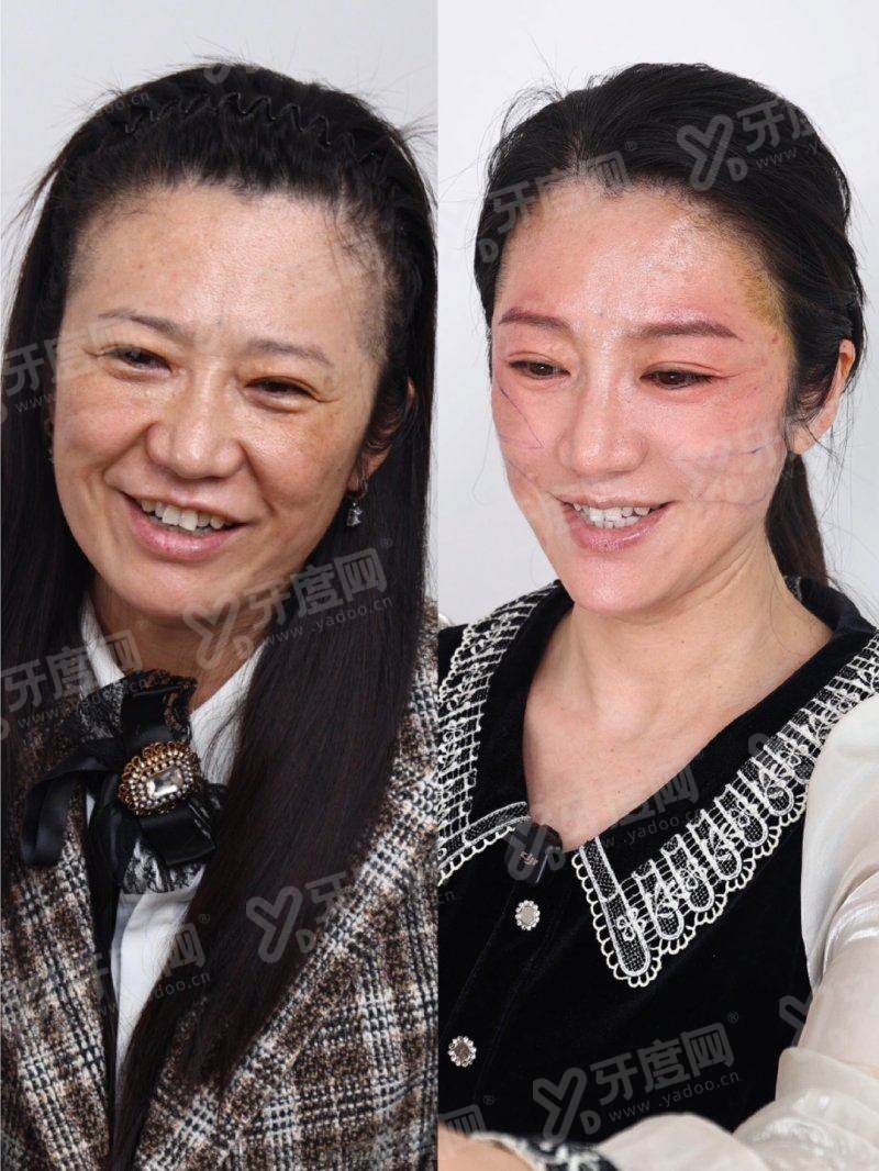 夏志冉医生面部提升如何预约？分层抗衰技术自然，附价格表与坐诊地址