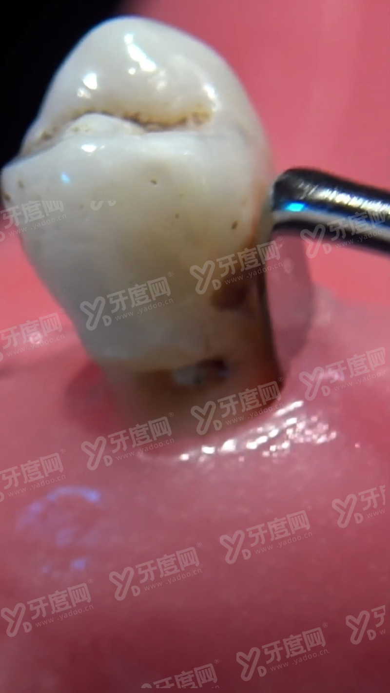 二、兰州皓亚口腔数字化种植与透明收费的真实体验yanke.yadoo.cn
