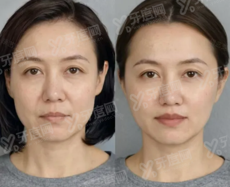 (二)术后成效平整自然