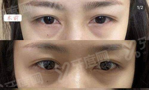 刘志刚眼修复价格表一览多少钱？双眼皮修复 8000 元起，自然灵动重塑迷人双眸！
