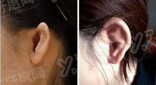 二、扬州施尔美去眼袋医生技术怎么样？真人实例反馈如何？yanke.yadoo.cn