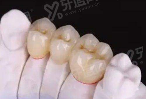 二、佛山登特口腔口碑怎么样?真实患者分享数字化种牙矫正的惊艳蜕变yanke.yadoo.cn