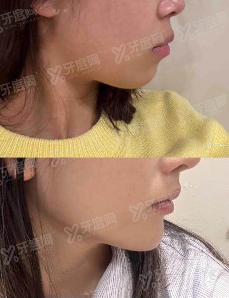 广州线雕提升医院排名哪家好？美莱、华美、紫馨、上榜！