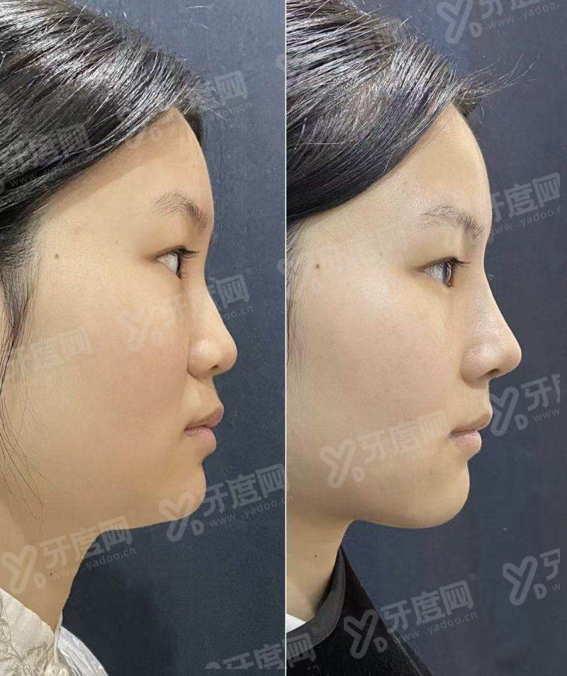 三、北京孙波舒适吸脂价格表yanke.yadoo.cn