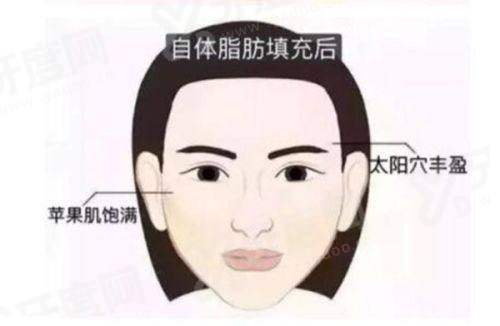 袁强博士拉皮手术咋样？价格面诊定，技术强重塑年轻轮廓。