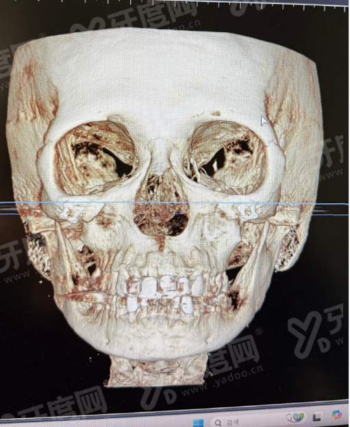 二、袁强博士拉皮手术怎么样yanke.yadoo.cn
