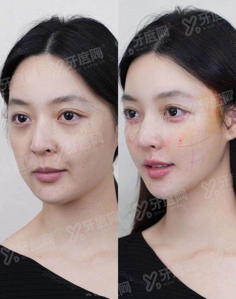 上海九院张余光双眼皮修复多少钱？约 2.8 万起，技术细腻自然灵动，重塑迷人双眼！
