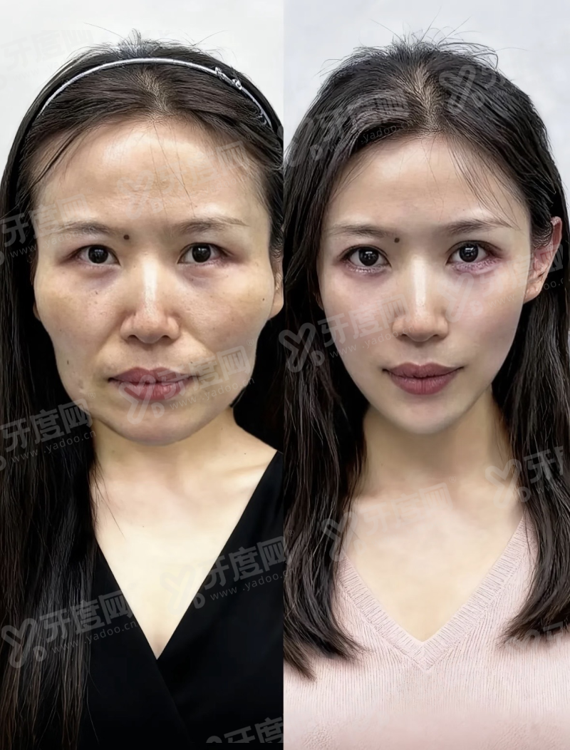 李世荣做男性生殖器延长增粗手术费用约8k元起，术后自然美观！